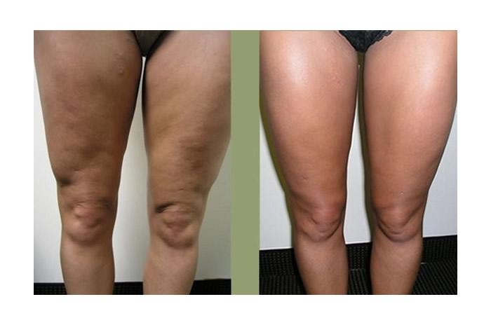 cellulite_treatments3-1