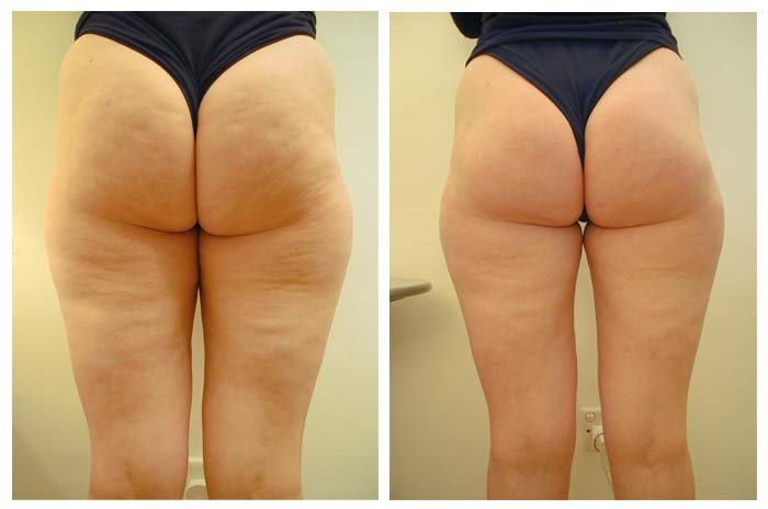 cellulite_treatments4-1