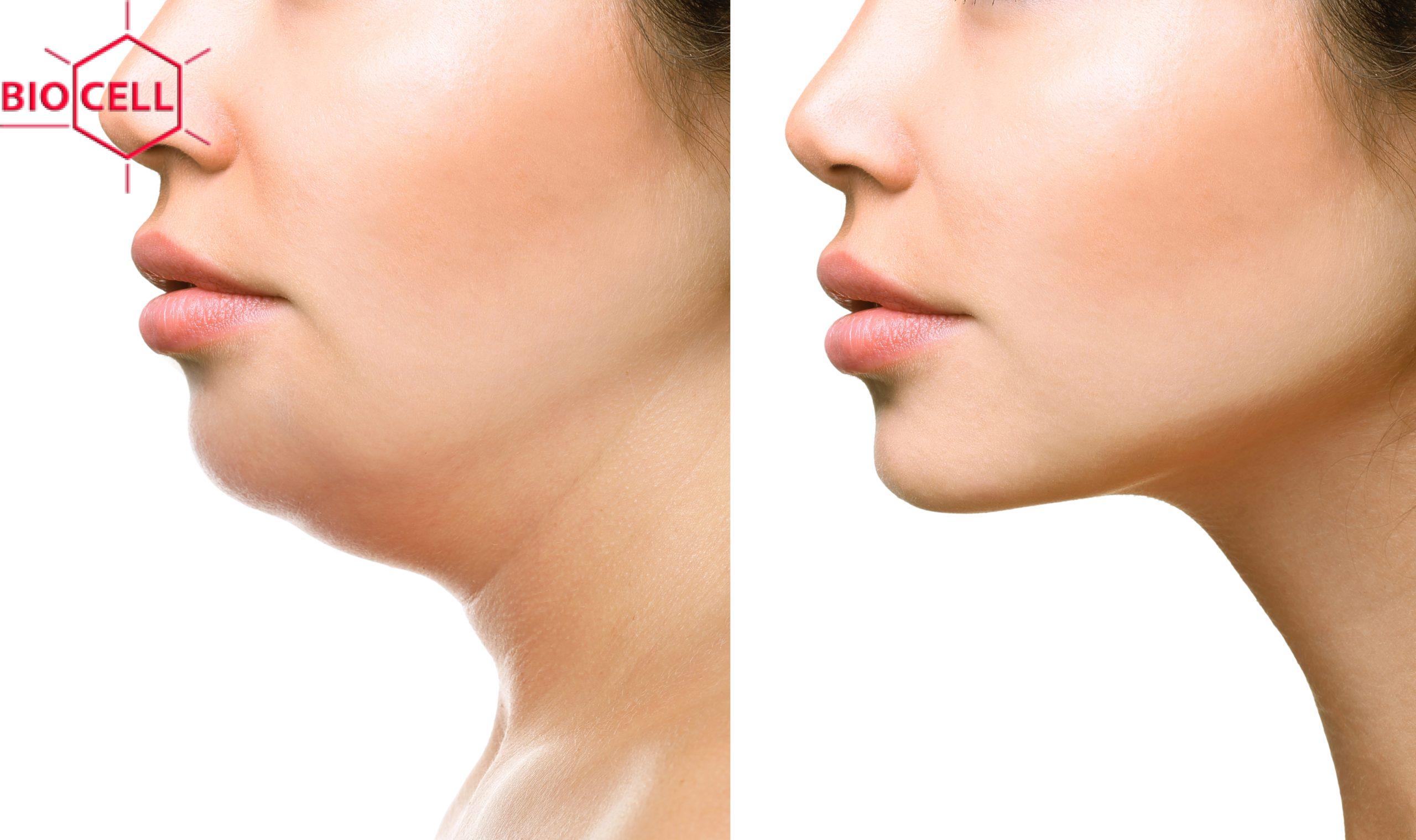 double chin treatment double chin treatment