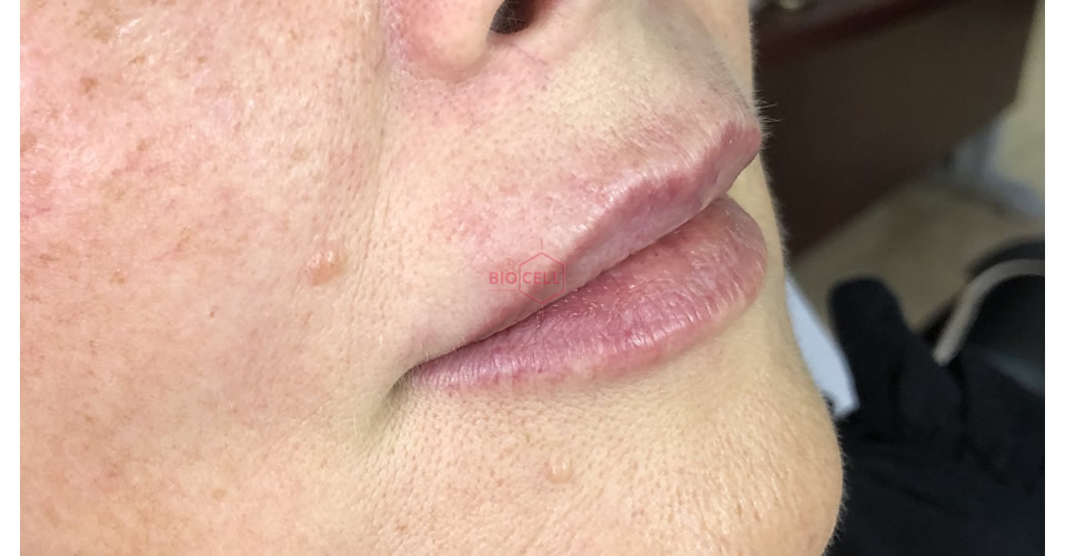 After-Lips Augmentation