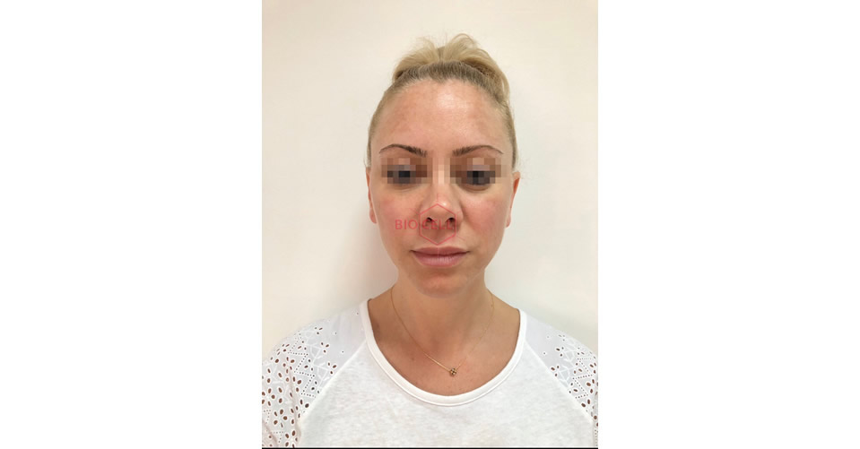 After-Complex Facial Recontouring with Juvederm Dermal Fillers