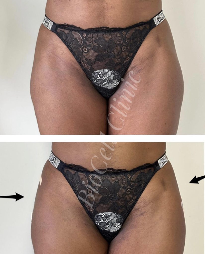 IMG-1 Butt Lift and Hip Enlargement