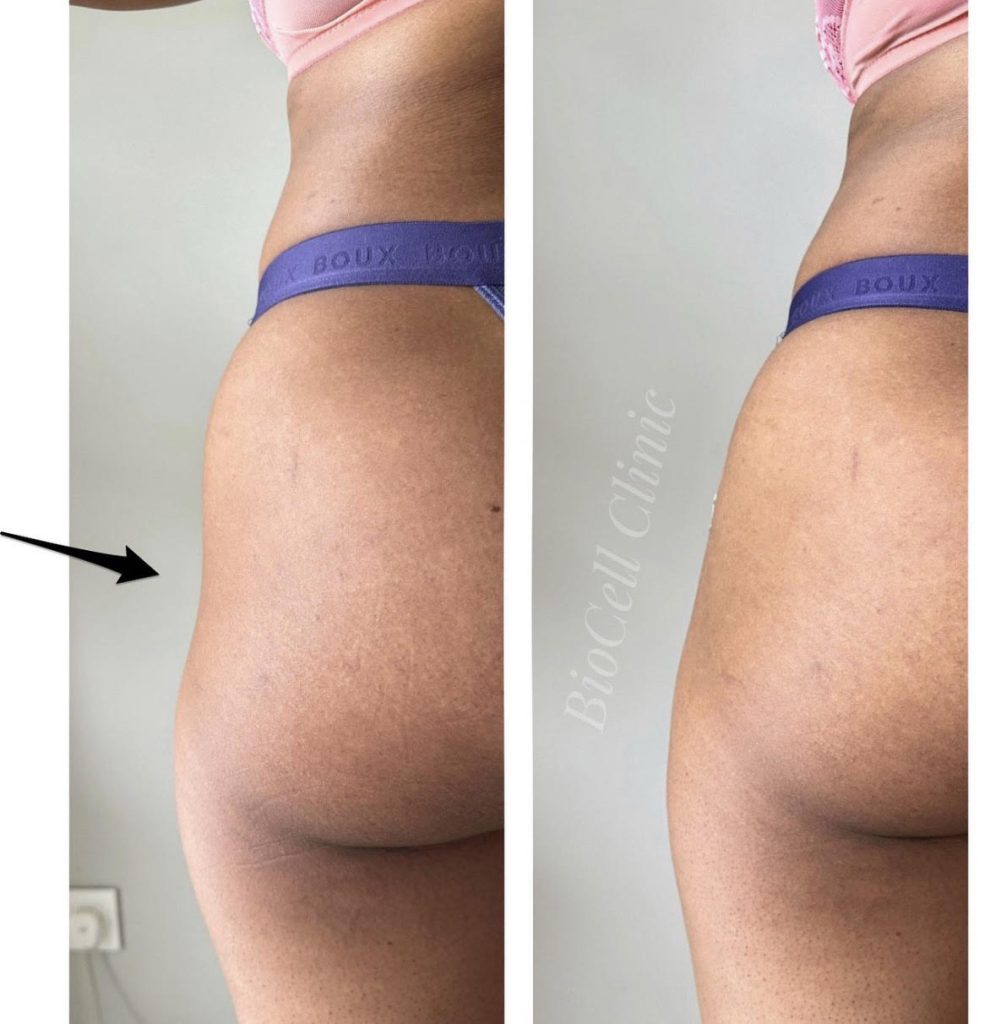 IMG-2 Butt Lift and Hip Enlargement