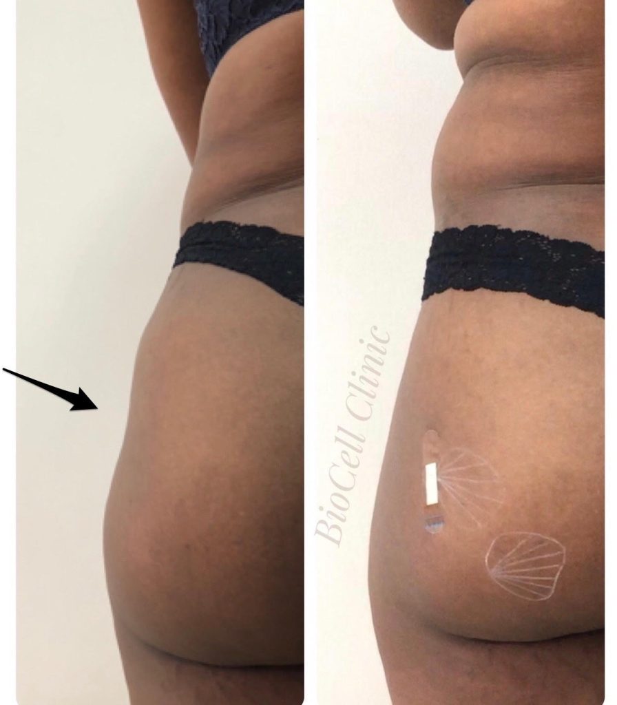 IMG-3 Butt Lift and Hip Enlargement