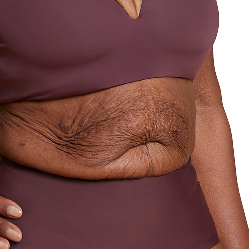 Sagging Skin Treatment