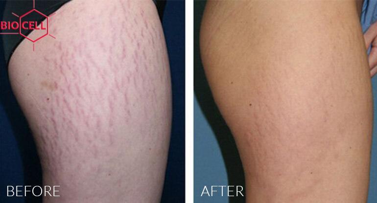 STRETCH MARKS Removal STRETCH MARKS Removal